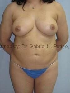  Before and After Cosmetic Surgery in Oakland, CA 