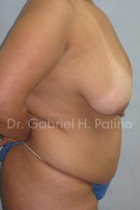 Before and After Cosmetic Surgery in Oakland, CA 