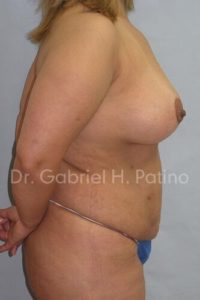  Before and After Cosmetic Surgery in Oakland, CA 