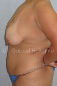  Before and After Cosmetic Surgery in Oakland, CA 