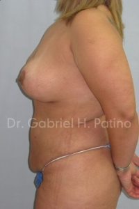  Before and After Cosmetic Surgery in Oakland, CA 