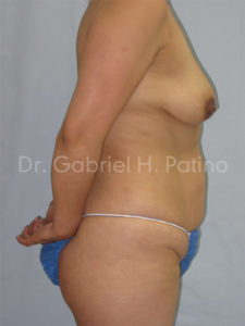  Before and After Cosmetic Surgery in Oakland, CA 