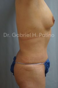  Before and After Cosmetic Surgery in Oakland, CA 