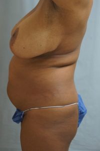  Before and After Cosmetic Surgery in Oakland, CA 