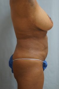  Before and After Cosmetic Surgery in Oakland, CA 