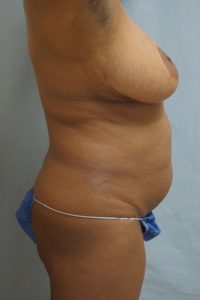  Before and After Cosmetic Surgery in Oakland, CA 