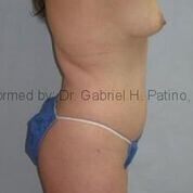  Before and After Cosmetic Surgery in Oakland, CA 