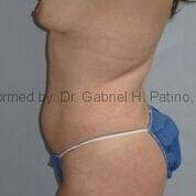  Before and After Cosmetic Surgery in Oakland, CA 