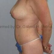  Before and After Cosmetic Surgery in Oakland, CA 