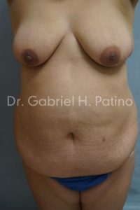  Before and After Cosmetic Surgery in Oakland, CA 