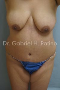  Before and After Cosmetic Surgery in Oakland, CA 