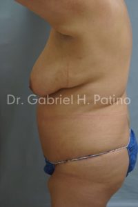  Before and After Cosmetic Surgery in Oakland, CA 