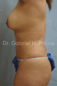  Before and After Cosmetic Surgery in Oakland, CA 