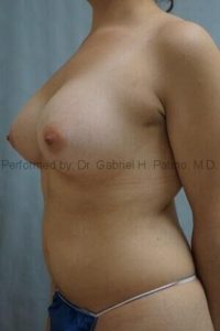  Before and After Cosmetic Surgery in Oakland, CA 