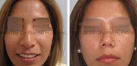 Rhinoplasty Treatment Before and After Pictures in Oakland, CA