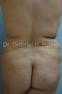  Before and After Cosmetic Surgery in Oakland, CA 