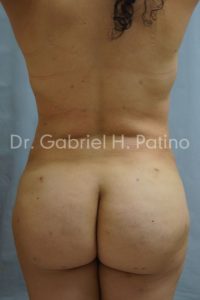  Before and After Cosmetic Surgery in Oakland, CA 