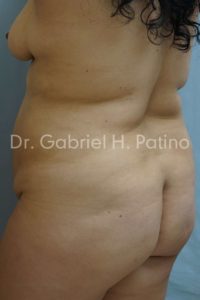  Before and After Cosmetic Surgery in Oakland, CA 