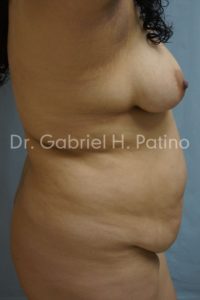  Before and After Cosmetic Surgery in Oakland, CA 