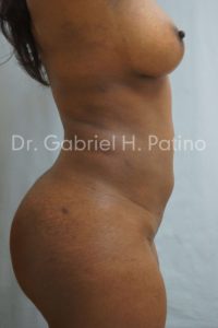  Before and After Cosmetic Surgery in Oakland, CA 