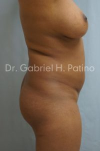  Before and After Cosmetic Surgery in Oakland, CA 