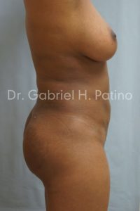  Before and After Cosmetic Surgery in Oakland, CA 