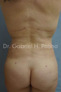  Before and After Cosmetic Surgery in Oakland, CA 