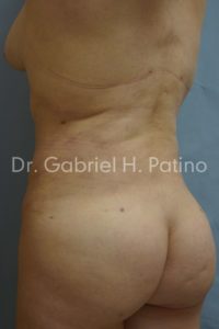  Before and After Cosmetic Surgery in Oakland, CA 