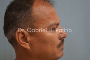  Before and After Cosmetic Surgery in Oakland, CA 