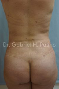  Before and After Cosmetic Surgery in Oakland, CA 