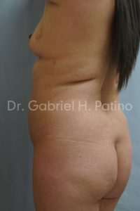  Before and After Cosmetic Surgery in Oakland, CA 