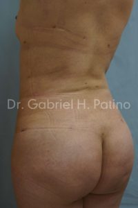  Before and After Cosmetic Surgery in Oakland, CA 