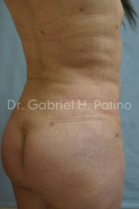  Before and After Cosmetic Surgery in Oakland, CA 