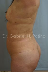  Before and After Cosmetic Surgery in Oakland, CA 