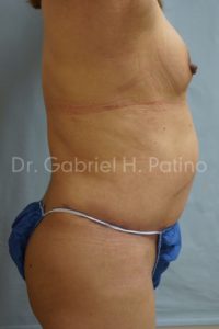  Before and After Cosmetic Surgery in Oakland, CA 