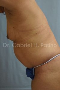  Before and After Cosmetic Surgery in Oakland, CA 