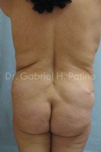  Before and After Cosmetic Surgery in Oakland, CA 