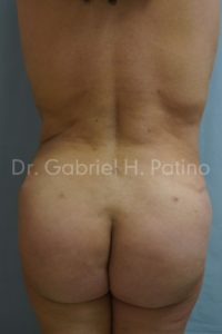  Before and After Cosmetic Surgery in Oakland, CA 