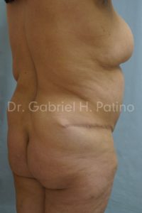  Before and After Cosmetic Surgery in Oakland, CA 