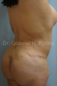  Before and After Cosmetic Surgery in Oakland, CA 