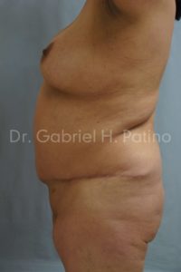  Before and After Cosmetic Surgery in Oakland, CA 