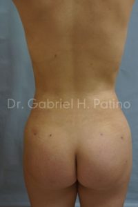  Before and After Cosmetic Surgery in Oakland, CA 