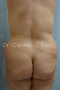  Before and After Cosmetic Surgery in Oakland, CA 