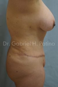  Before and After Cosmetic Surgery in Oakland, CA 