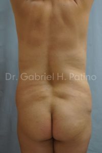  Before and After Cosmetic Surgery in Oakland, CA 