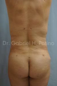  Before and After Cosmetic Surgery in Oakland, CA 