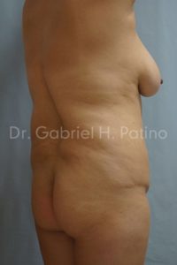  Before and After Cosmetic Surgery in Oakland, CA 