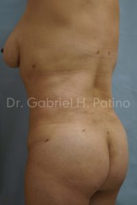  Before and After Cosmetic Surgery in Oakland, CA 