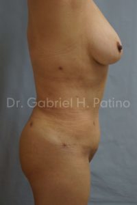  Before and After Cosmetic Surgery in Oakland, CA 