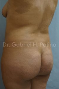  Before and After Cosmetic Surgery in Oakland, CA 